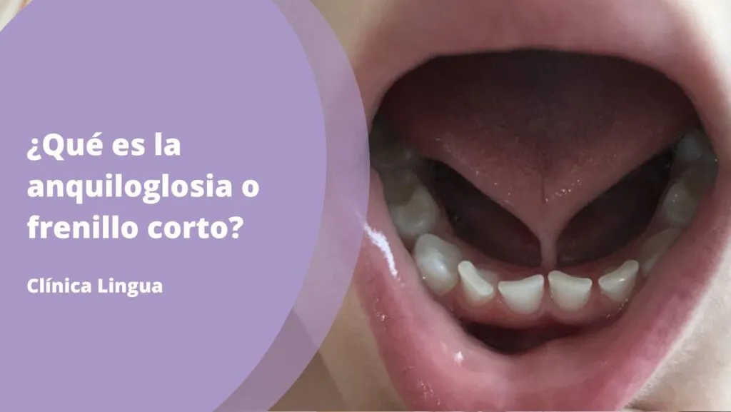 Ejemplo de anquiloglosia o frenillo corto